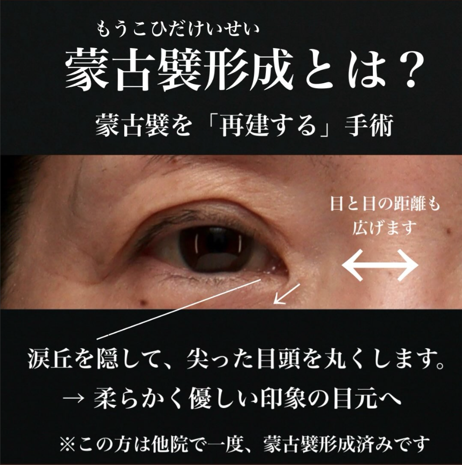 他院蒙古襞形成後の再手術で目頭の角度を柔らかくし優しい印象にした症例（術後3ヶ月） 画像2