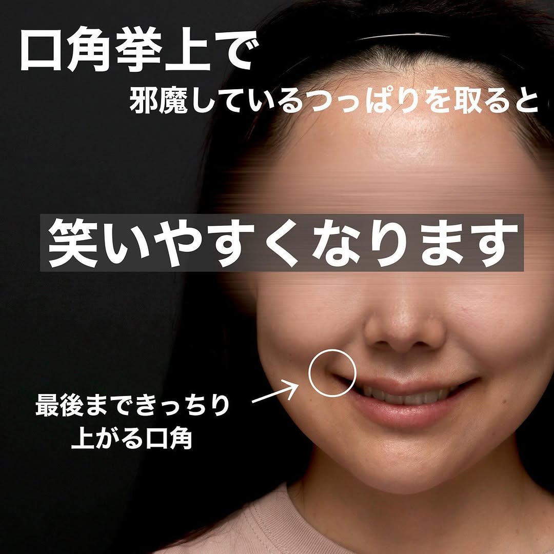 口角挙上で笑顔としゃべりやすさも改善した術後3ヶ月の長期経過症例 画像3