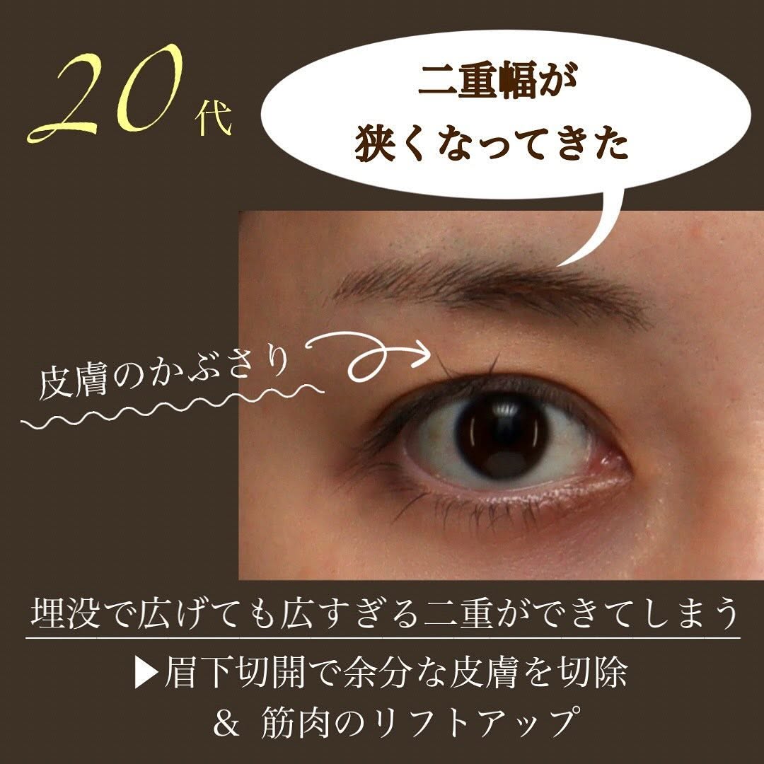 20代の眉下切開でまぶたの被さりを改善し本来の二重ラインを取り戻した症例 画像3