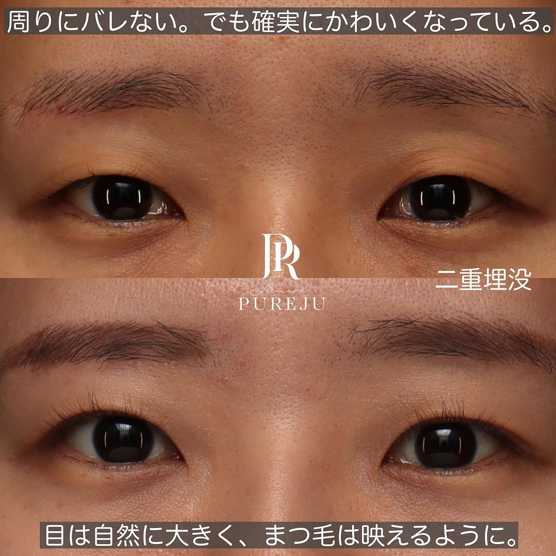 骨格に合わせた自然な末広二重で周りにバレない変化を実現した症例
