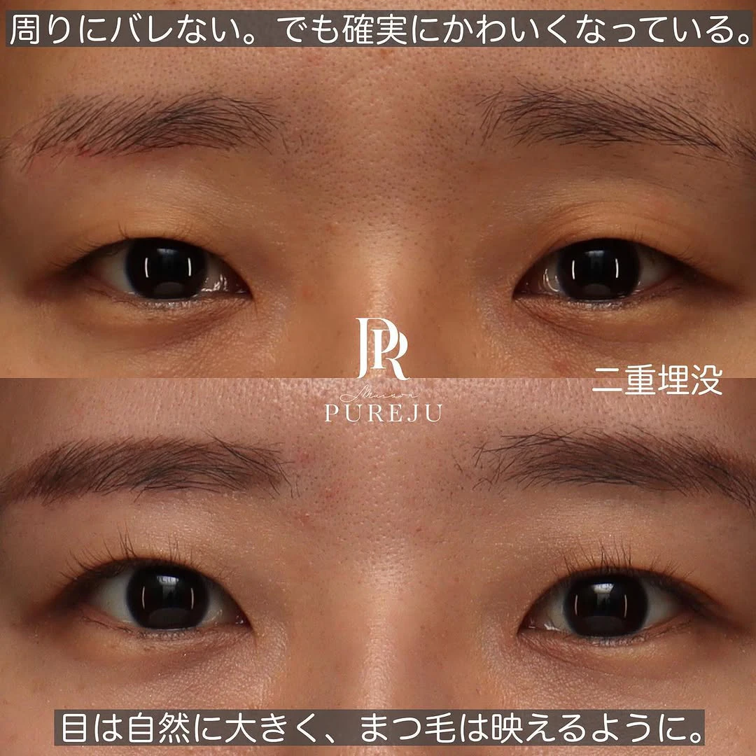 骨格に合わせた自然な末広二重で周りにバレない変化を実現した症例