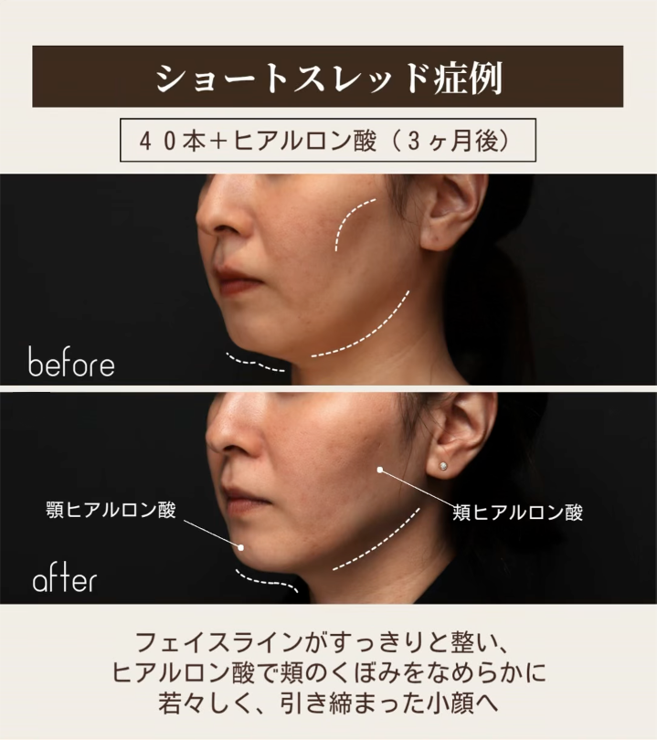ショートスレッド＋ヒアルロン酸でフェイスラインを引き締め頬のくぼみを整えた症例（3ヶ月後） 画像2