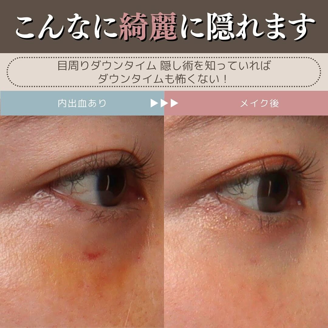 目周りのダウンタイムを隠す方法｜服装アイテムと内出血を消すコンシーラーの使い方 画像4