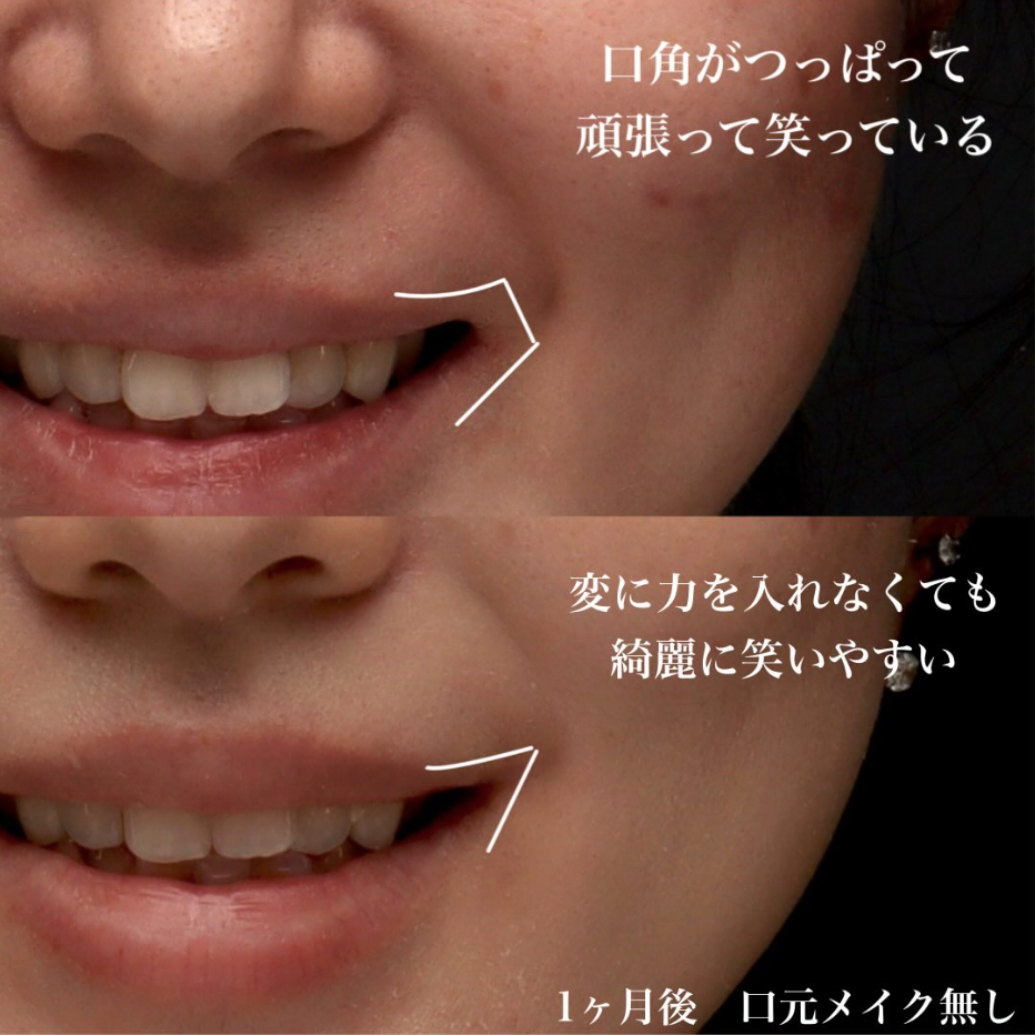 口角挙上で口角のつっぱりを解除し無理なく自然に笑える口元にした症例（術後1ヶ月） 画像2