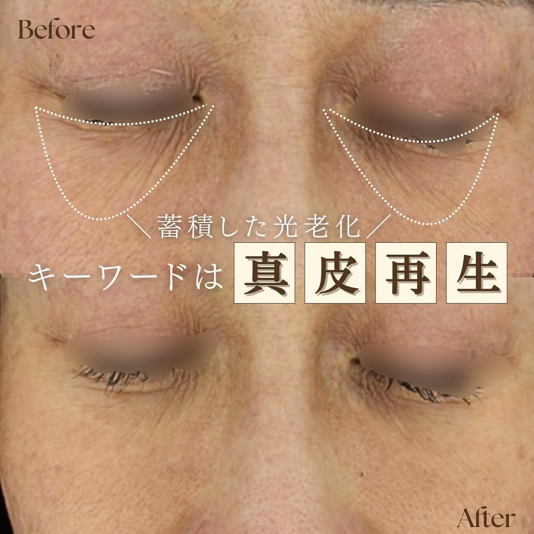 シルキー注射（スキンブースター）で光老化による真皮ダメージを根本から改善した症例