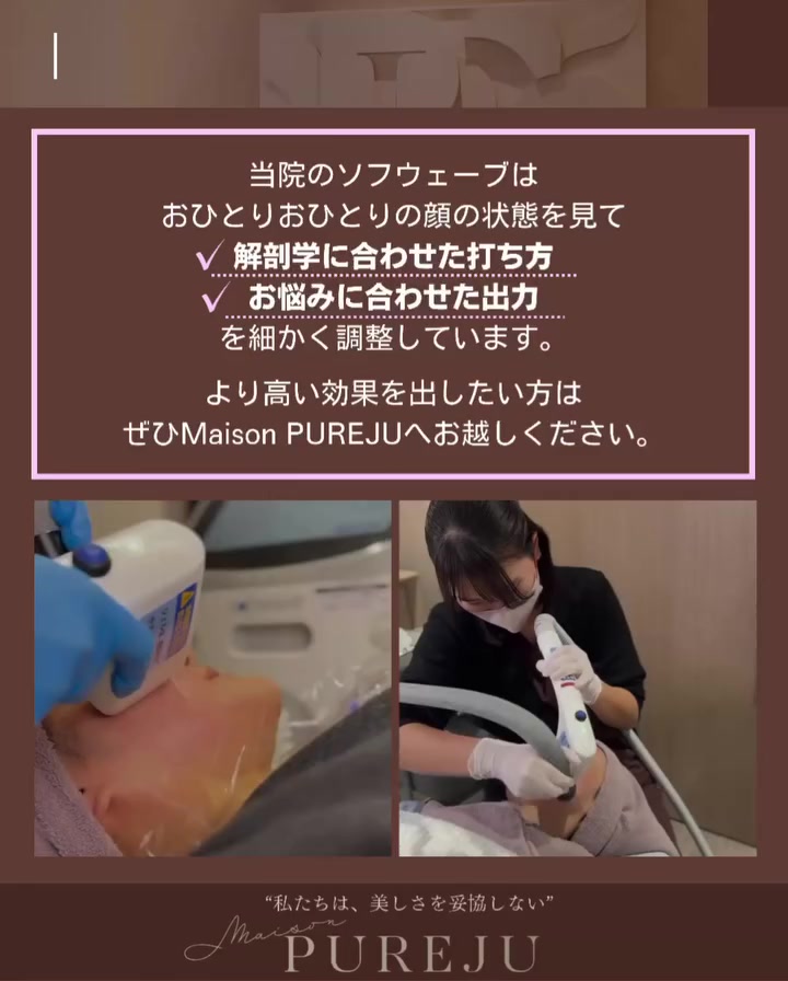 ソフウェーブで30代のフェイスラインのたるみをピタッと引き締めた症例 画像4