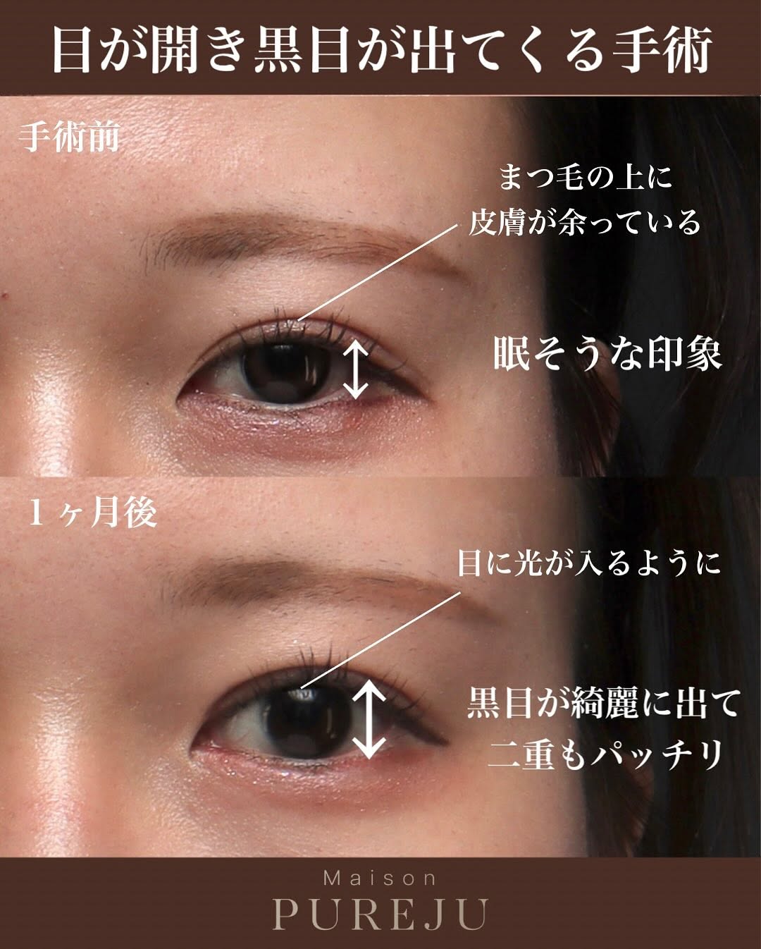 眼瞼下垂手術で隠れた黒目を見せ目の開きと印象を大きく改善した症例 画像2