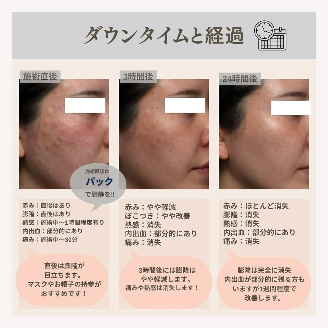 シルキー注射＋ジャルプロスーパーハイドロの肌育で目周りの小じわと乾燥を改善した症例 画像5