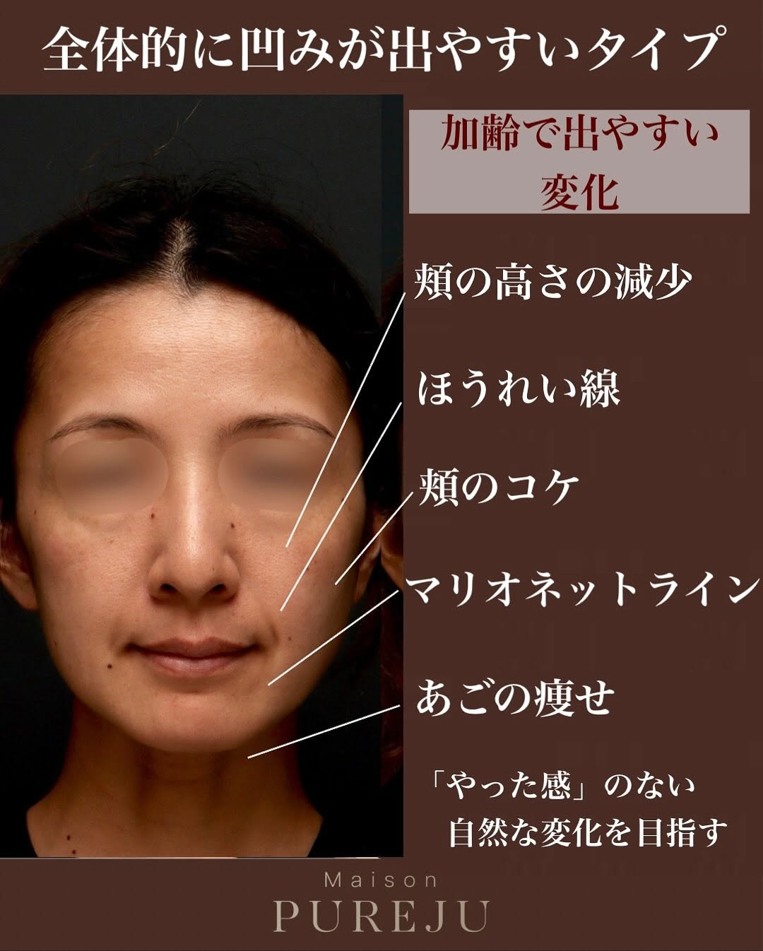 ヒアルロン酸注射でバランス良く整え自然にリフトアップした症例 画像2