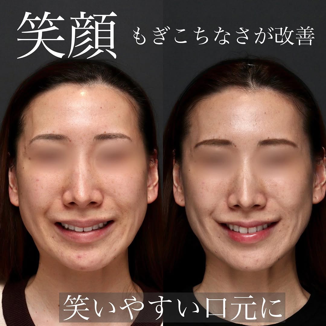 口角形成で真顔でも笑顔でも印象が上がった症例 画像2