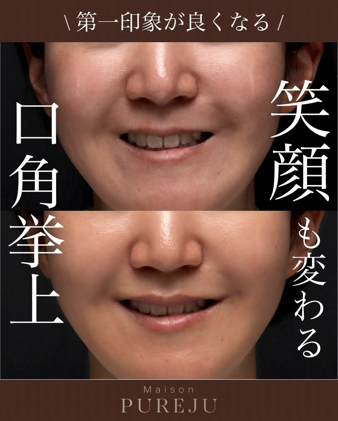 口角挙上で口角のつっぱりを解除し笑顔が変わった症例