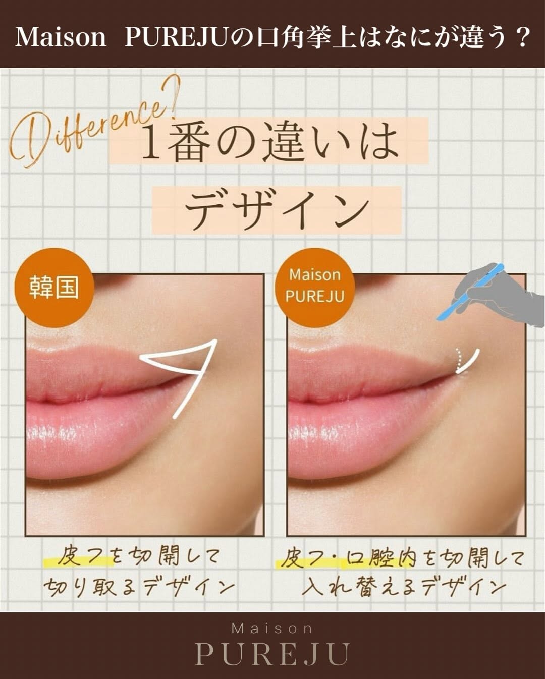 口角挙上＋ショートスレッドで印象アップと輪郭の引き締めを同時に実現した症例 画像2