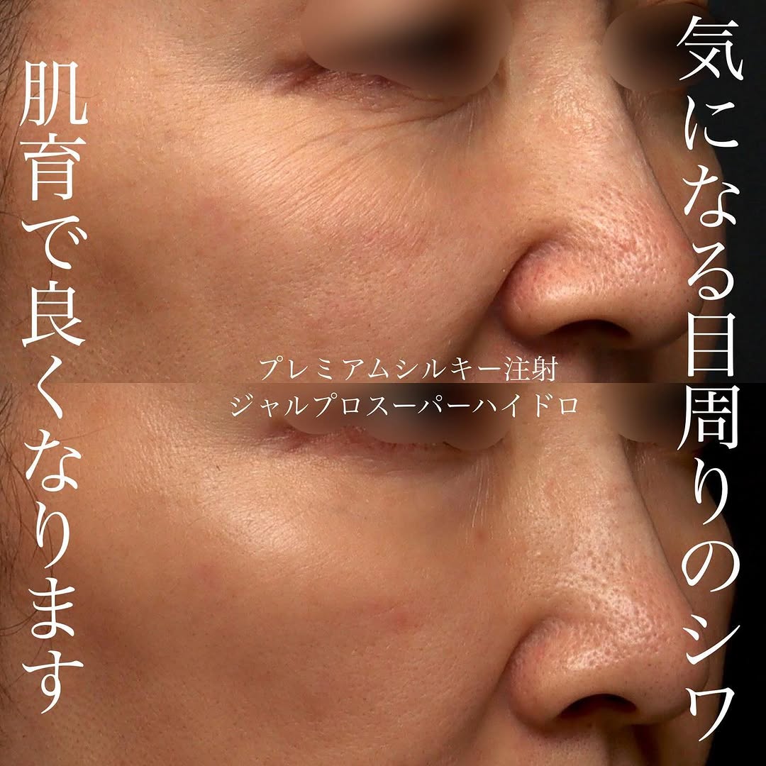 シルキー注射＋ジャルプロスーパーハイドロの肌育で目周りの小じわと乾燥を改善した症例