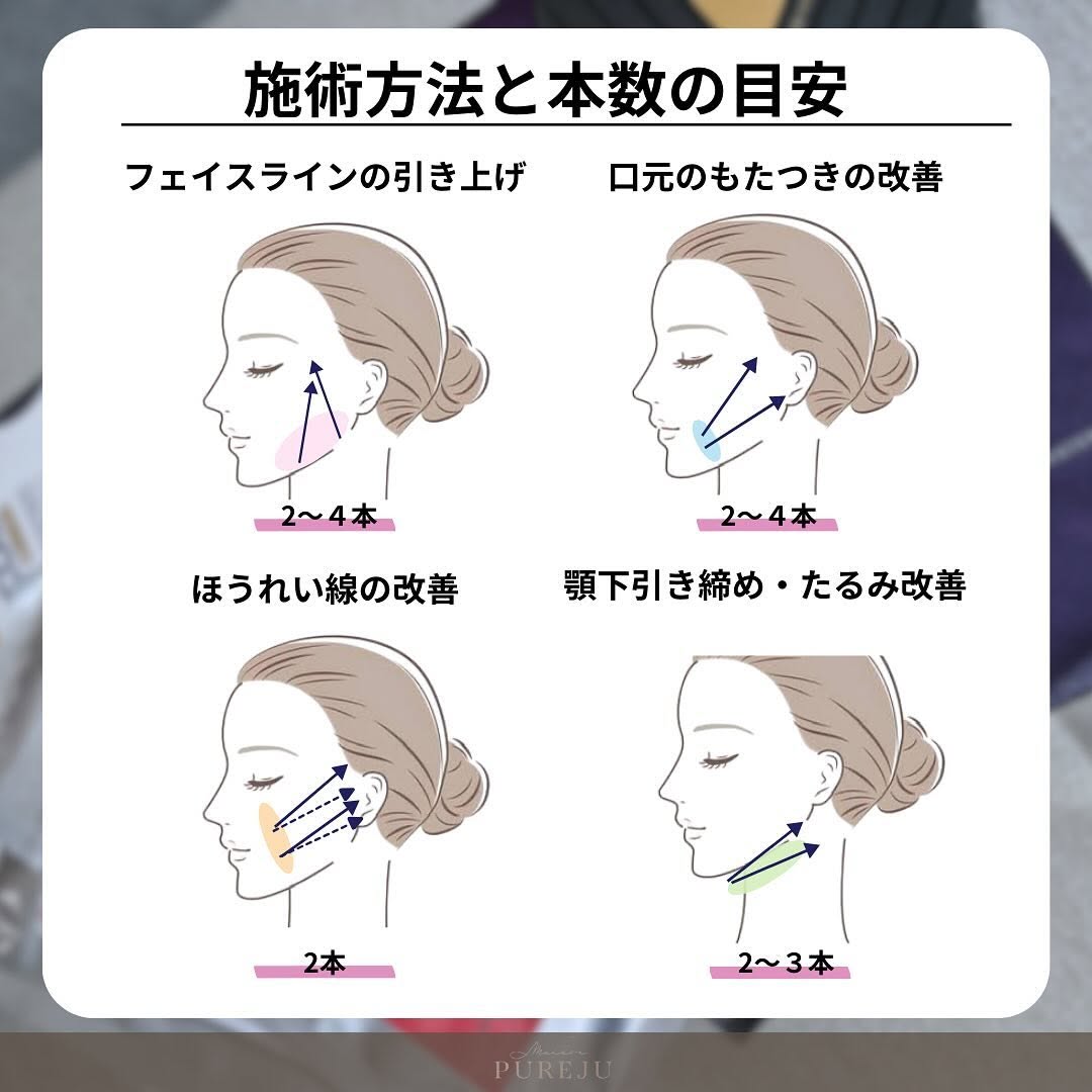 糸リフトとは｜種類・材質・本数の目安からMaison PUREJUの3プランまで徹底解説 画像5