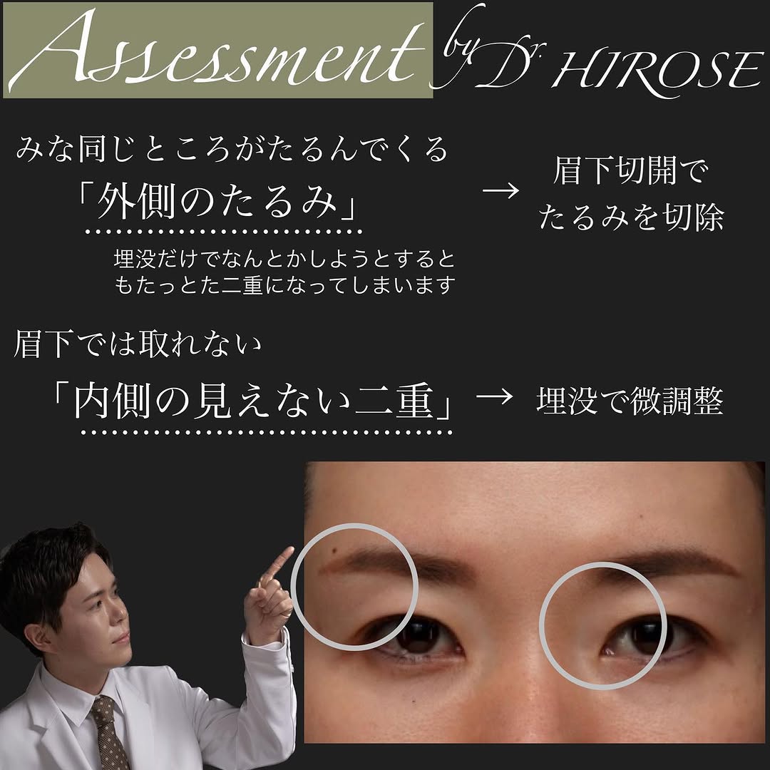 眉下切開＋二重埋没でたるみで隠れていた二重ラインをすっきり出した症例 画像3