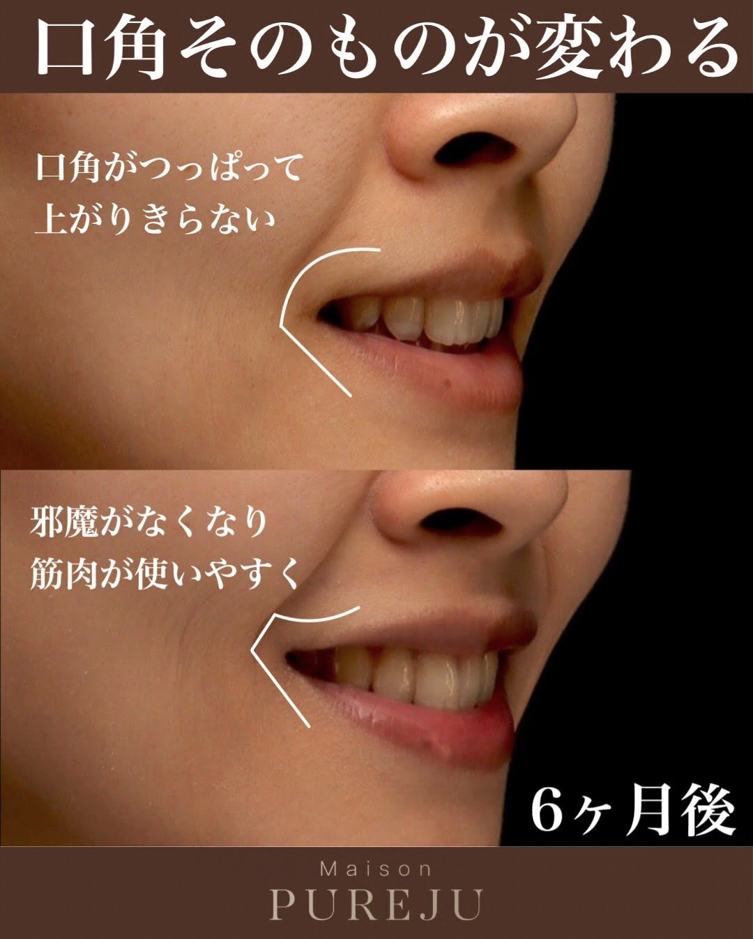 口角挙上で笑顔のぎこちなさを改善し自信を持って笑えるようになった症例 画像2