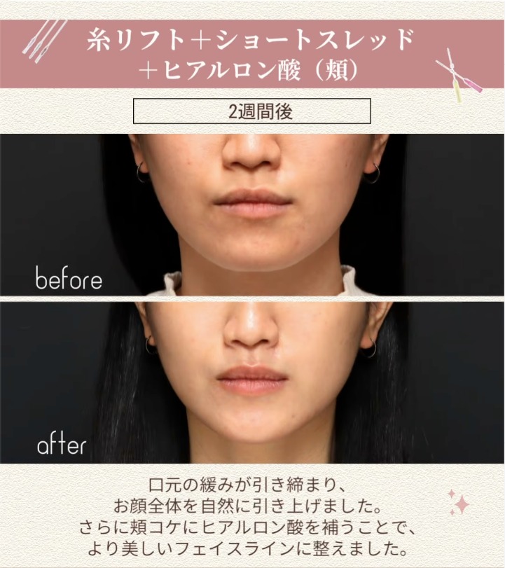糸リフト＋ショートスレッド＋ヒアルロン酸で口元のゆるみと頬コケを整えた小顔治療の症例（2週間後） 画像2