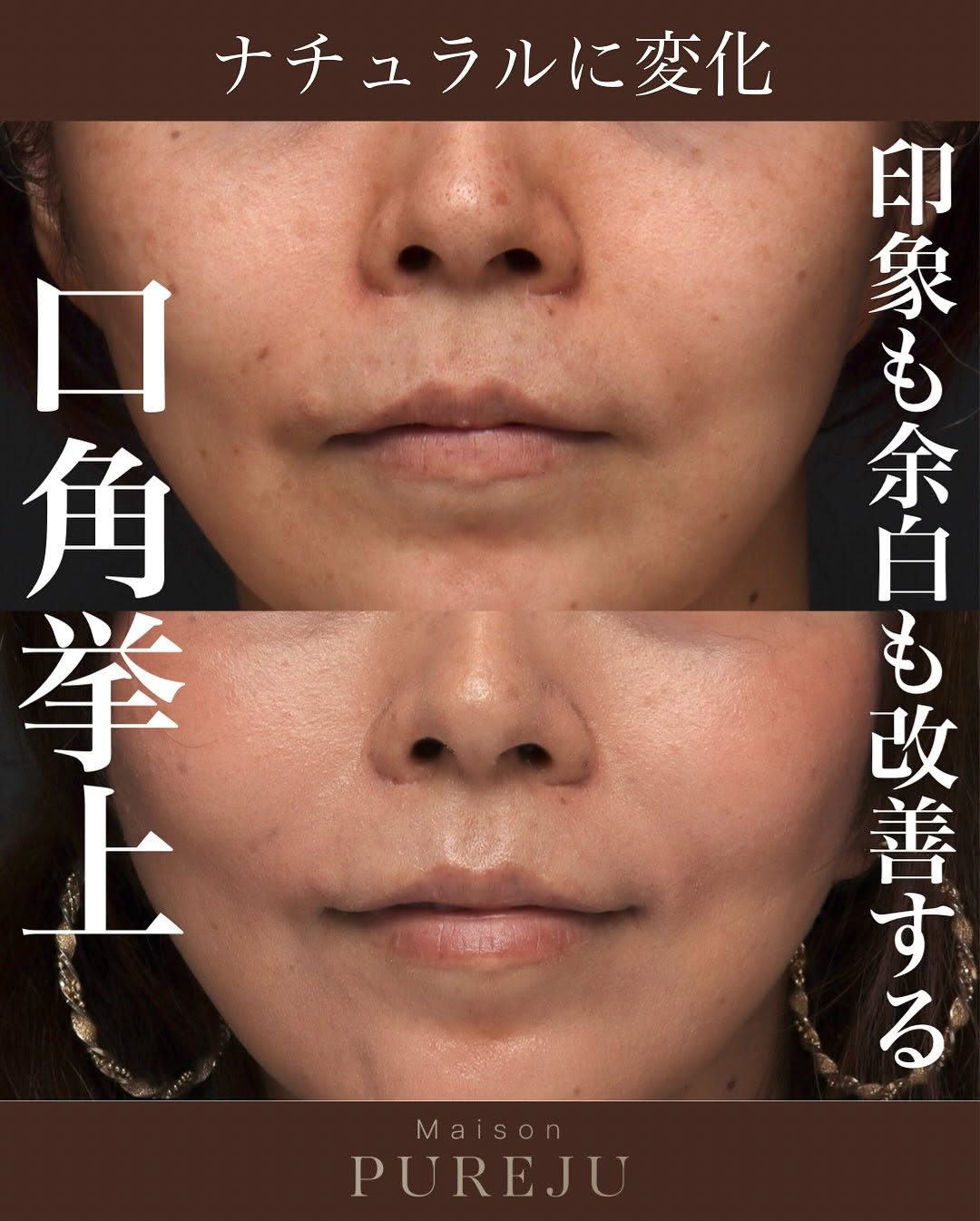 口角挙上＋ショートスレッドで印象アップと輪郭の引き締めを同時に実現した症例