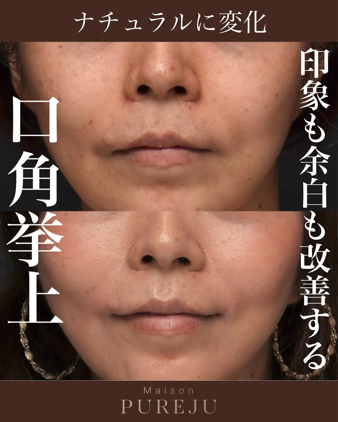 口角挙上+ショートスレッドで印象アップと輪郭の引き締めを同時に実現した症例