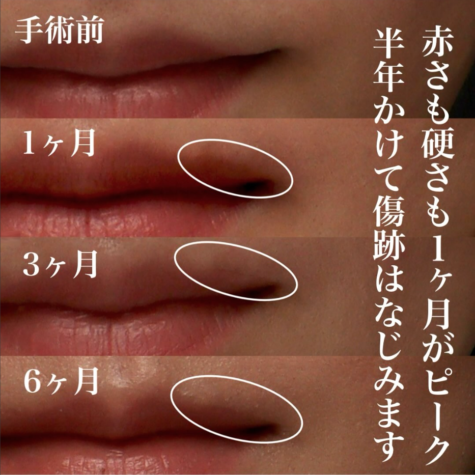 外側人中短縮の傷跡の半年経過、赤みと硬さのピークから馴染むまで（術後6ヶ月・メイクなし） 画像2