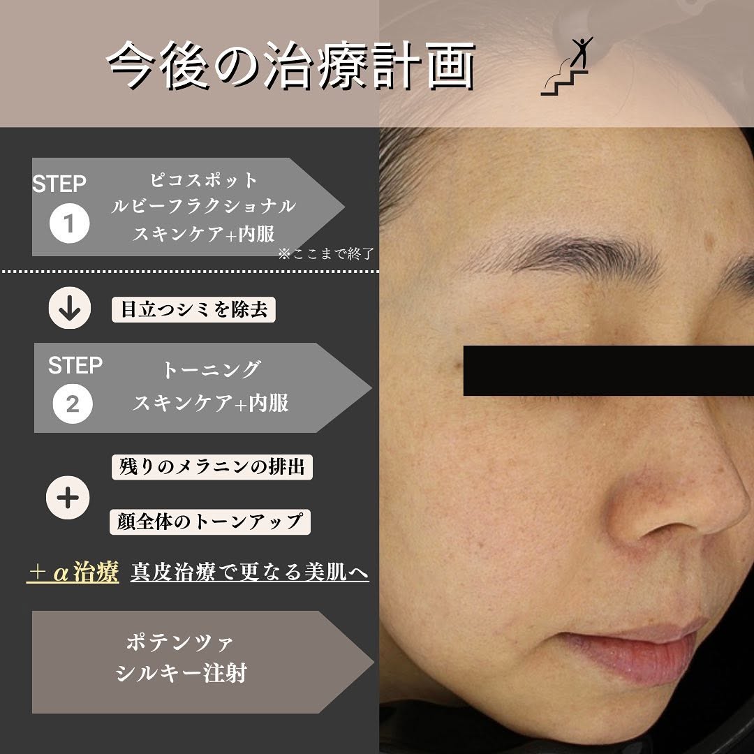 シミ治療の3ステップ｜プレ・照射・アフターケアまで一貫して行うMaison PUREJUのアプローチ 画像3