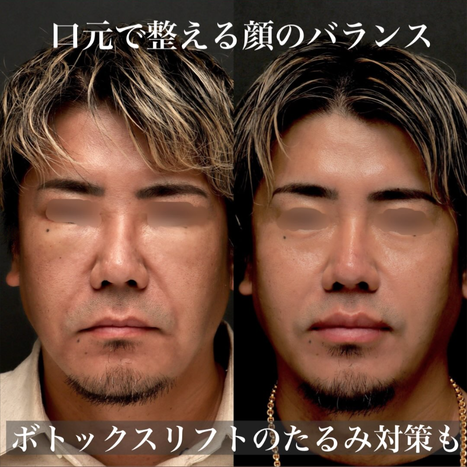 人中短縮＋外側人中短縮＋ヒアルロン酸＋ボトックスで中顔面を短縮し若返らせた男性症例（術後1ヶ月） 画像3