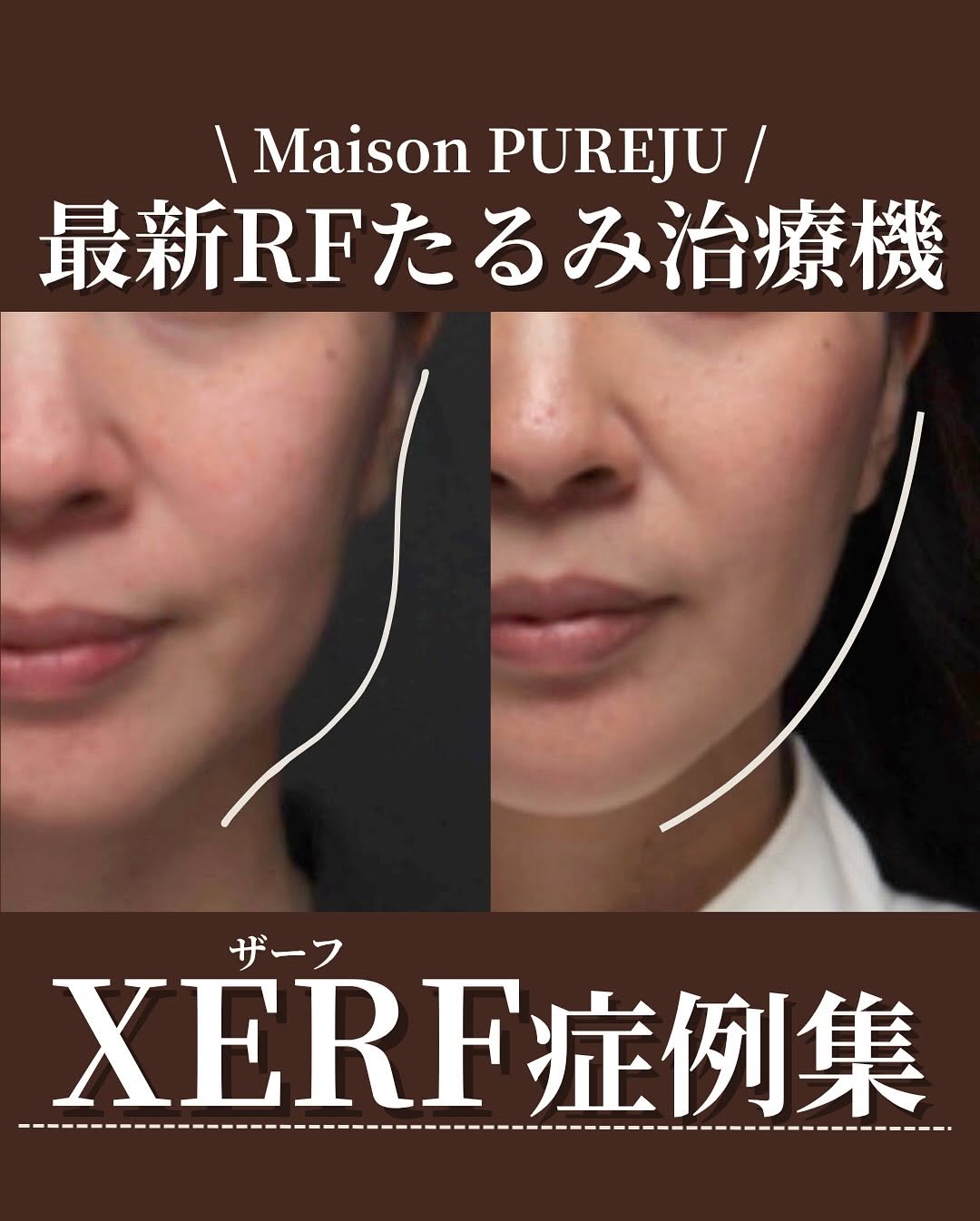 XERF（ザーフ）症例集｜痛みが少ない最新RFたるみ治療の効果と術後の変化