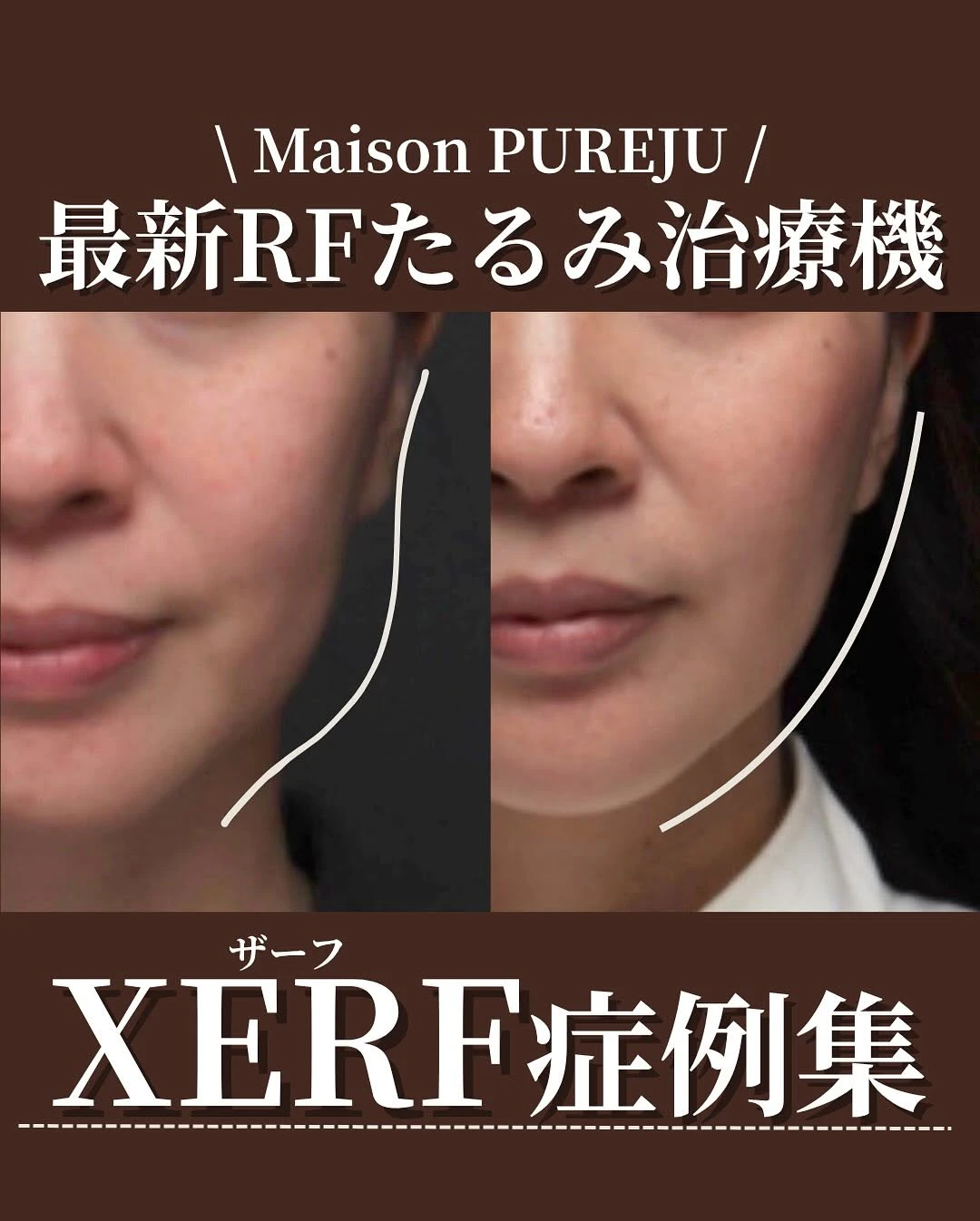 XERF(ザーフ)症例集|痛みが少ない最新RFたるみ治療の効果と術後の変化