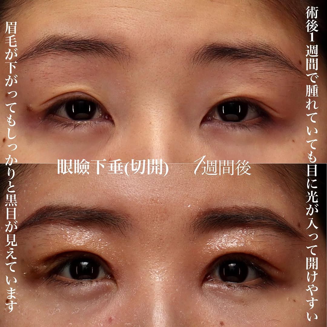 眼瞼下垂手術（切開法）で目の開きと眉の左右差を改善した症例（術後1週間） 画像2