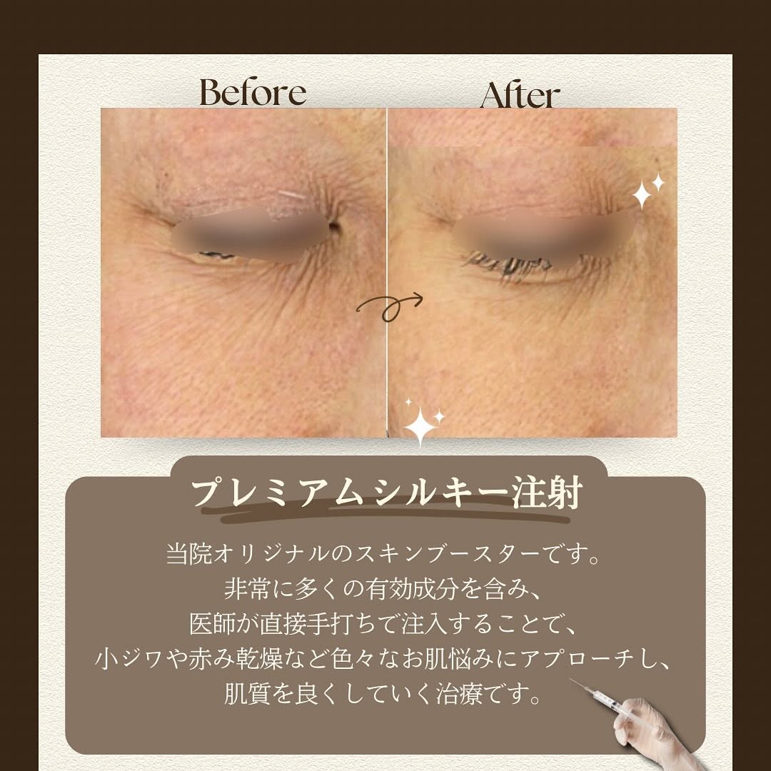シルキー注射（スキンブースター）で光老化による真皮ダメージを根本から改善した症例 画像4