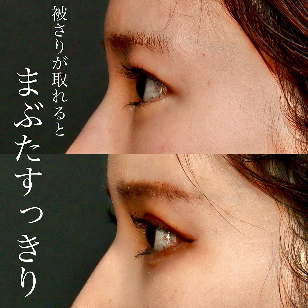 眉下切開でまぶたのもたつきをすっきり改善した症例（術後6ヶ月） 画像3