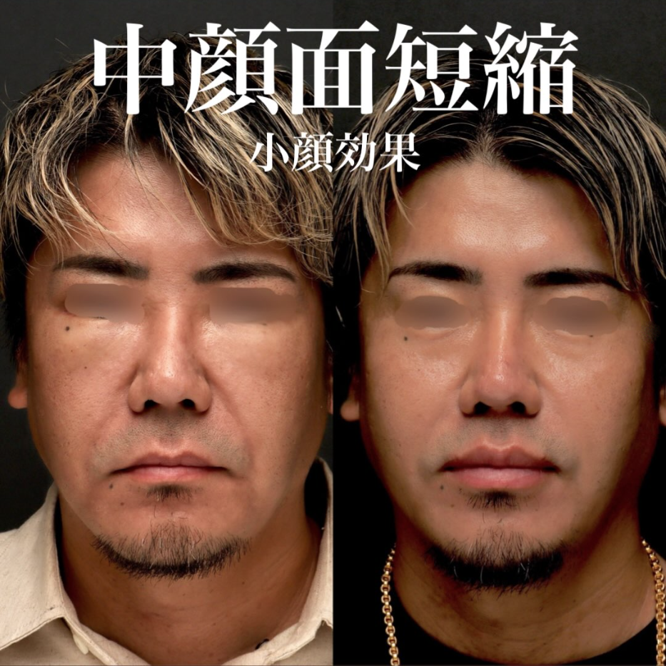 人中短縮＋外側人中短縮＋ヒアルロン酸＋ボトックスで中顔面を短縮し若返らせた男性症例（術後1ヶ月）