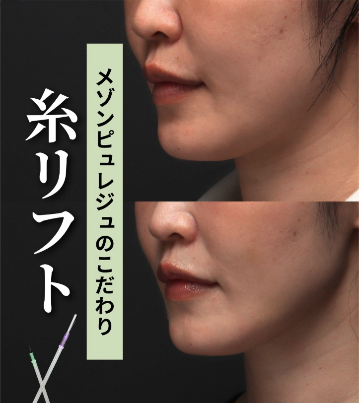 糸リフト＋ショートスレッドであご下のもたつきを引き締め横顔の輪郭を整えた症例（1ヶ月後）