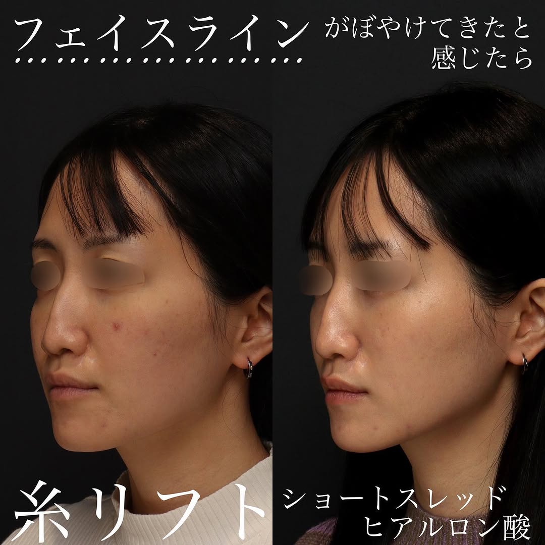 糸リフト＋ショートスレッド＋ヒアルロン酸でフェイスラインをすっきり整えた症例 画像2