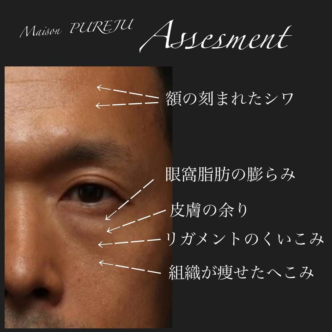 表ハムラ＋ヒアルロン酸注射＋シルキー注射で男性の自然な若返りを実現した症例（半年以上後）