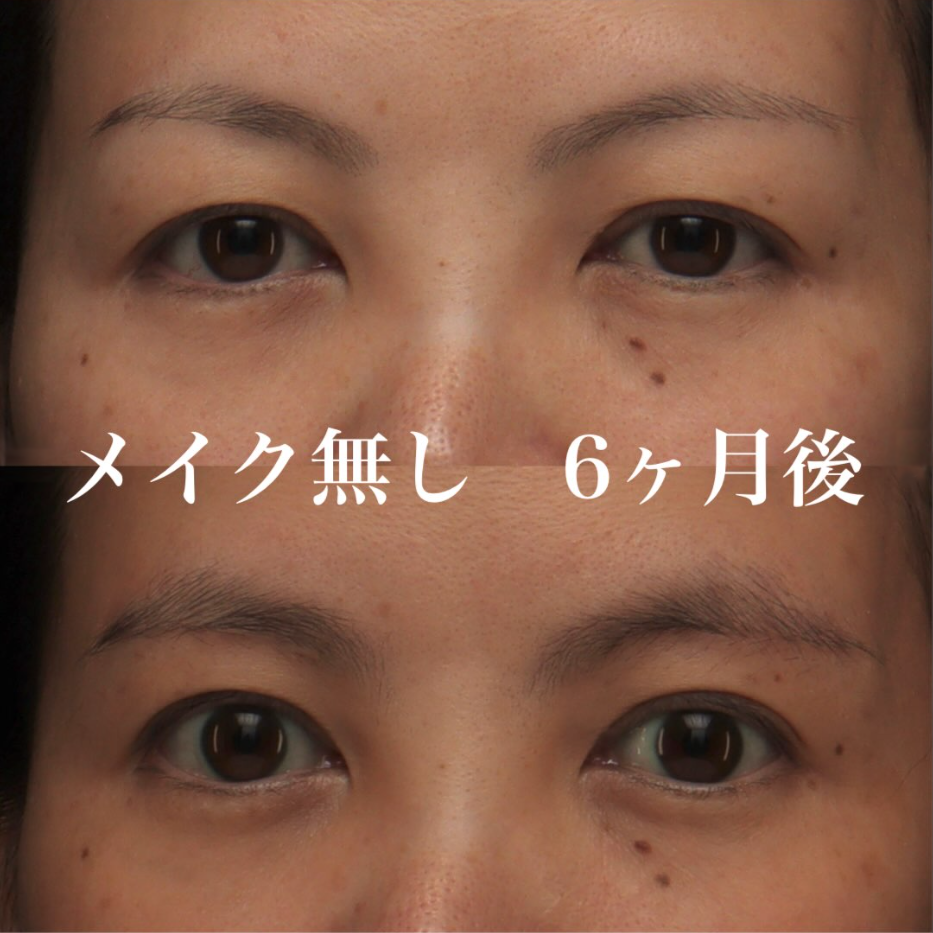 眉下切開で目尻側のたるみを取り自然に目元を若返らせた症例（術後6ヶ月・メイクなし） 画像2
