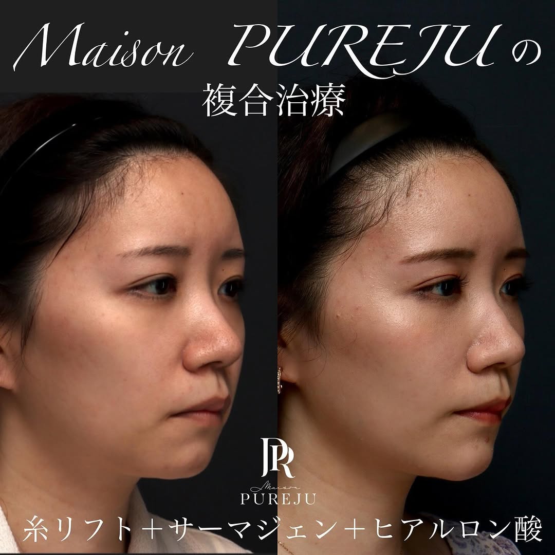 糸リフト＋サーマジェン＋ヒアルロン酸＋ボトックスのコンビネーションでバランス良く小顔に整えた症例 画像5