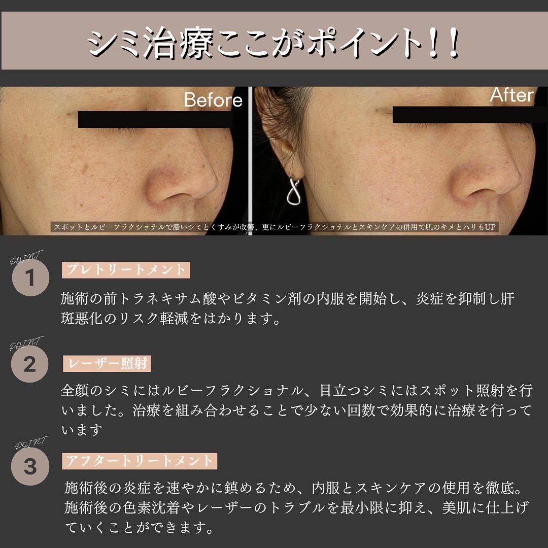シミ治療の3ステップ｜プレ・照射・アフターケアまで一貫して行うMaison PUREJUのアプローチ 画像2