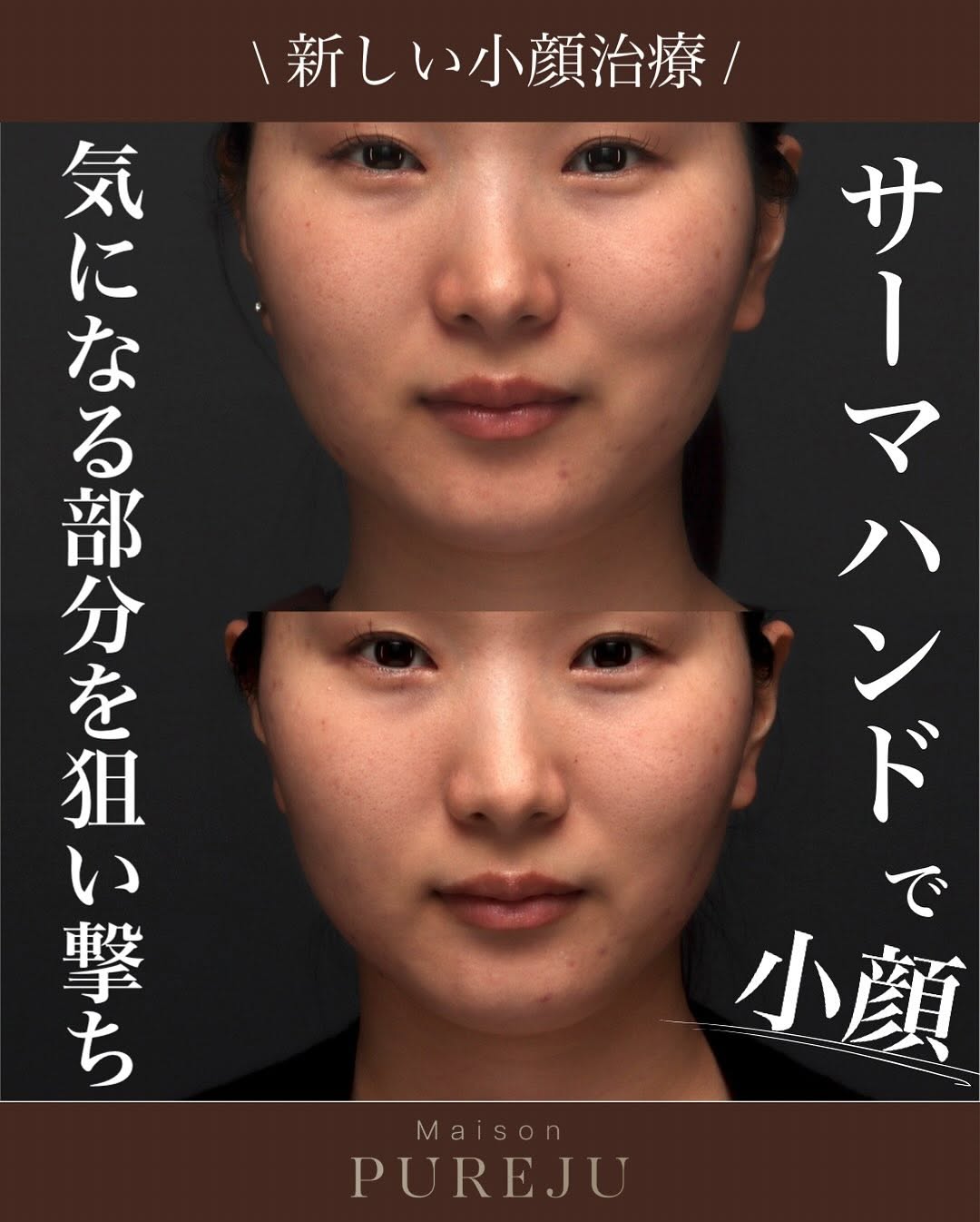 サーマハンドとは？指先から高周波を出すオーダーメイドたるみ治療の新機器 画像4