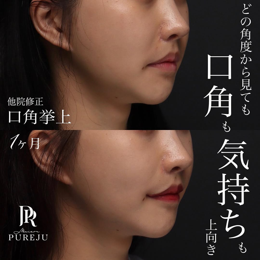 他院修正の口角挙上でしっかりと口角を上げ印象を改善した症例（術後1ヶ月）