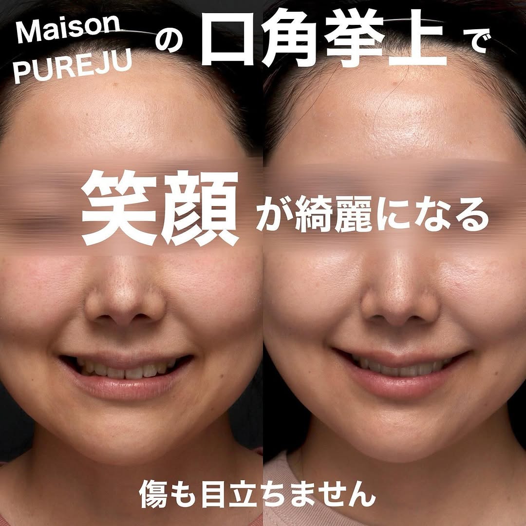 口角挙上で笑顔としゃべりやすさも改善した術後3ヶ月の長期経過症例 画像4
