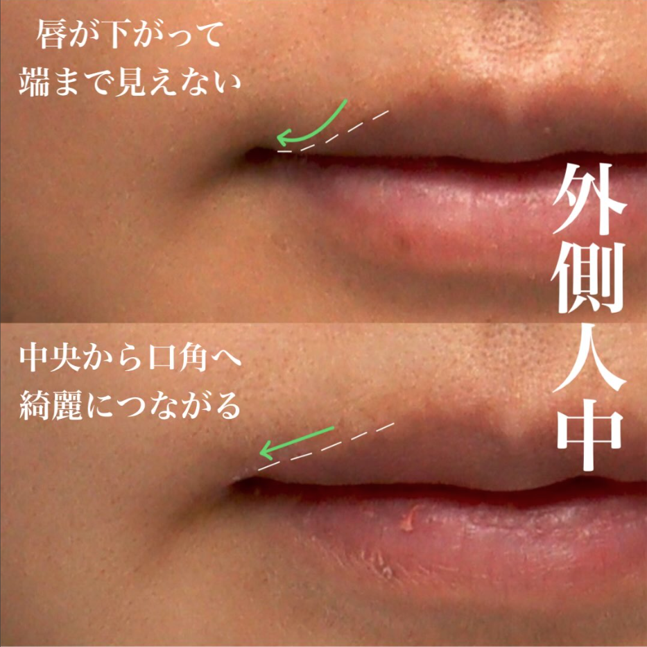 外側人中短縮で唇の端まで見えるバランスの良い口元にした症例（術後6ヶ月・メイクなし） 画像2