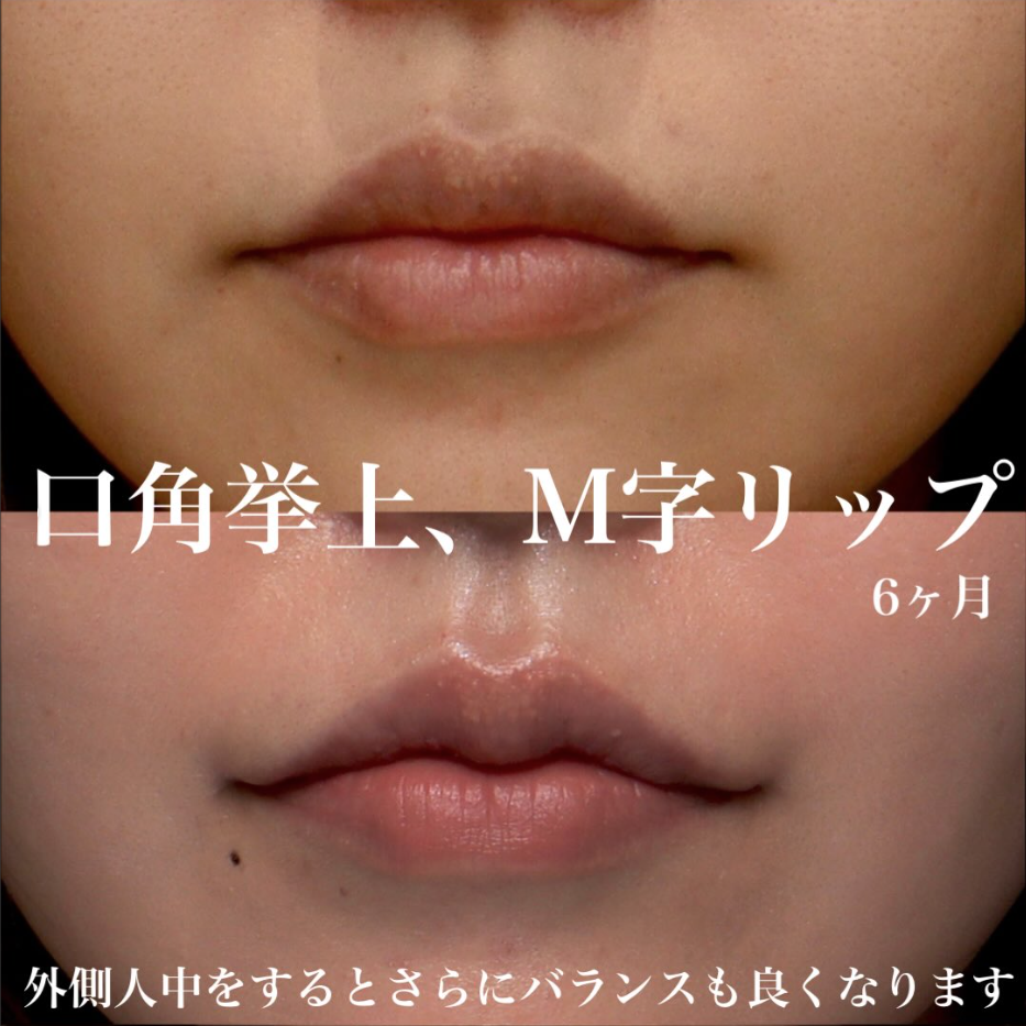 口角挙上＋M字リップで笑顔のぎこちなさを改善し丸みのある口元に整えた症例（術後6ヶ月） 画像2