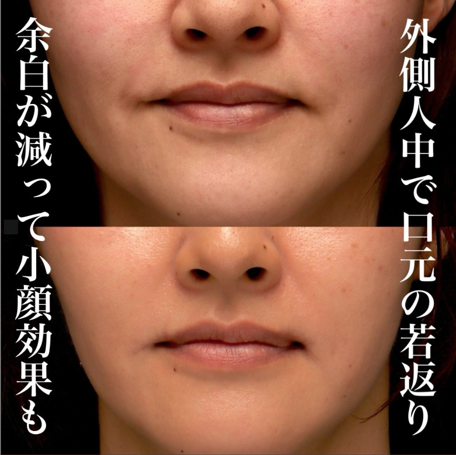 外側人中短縮で唇のかぶさりを改善し本来の口角が見えるようになった症例（術後3ヶ月） 画像2