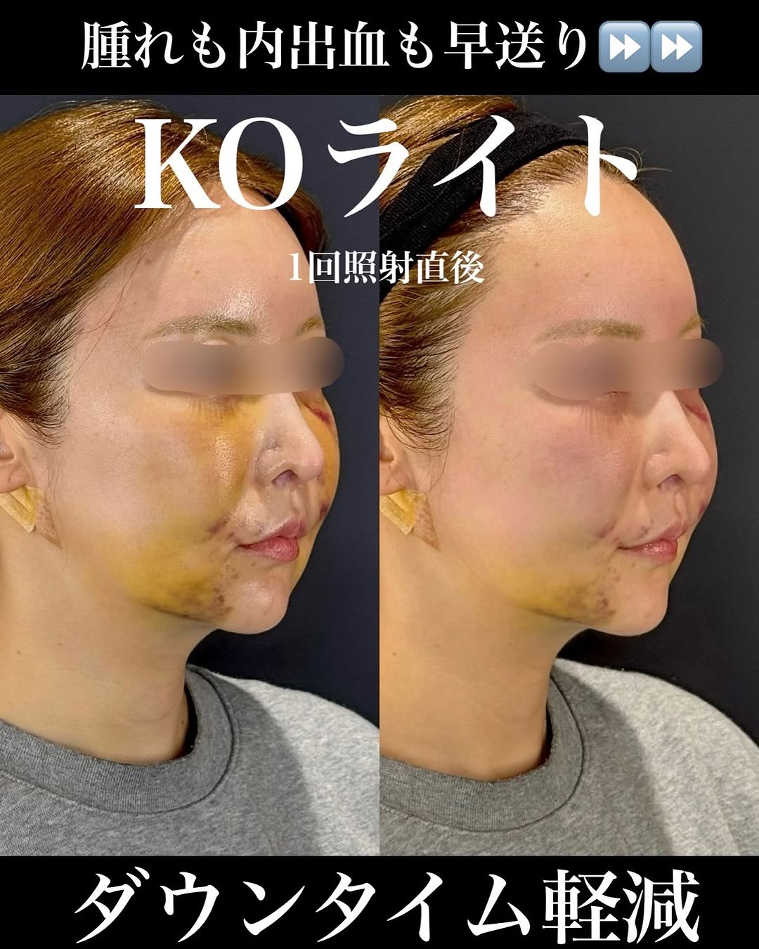 KOライトでゴールデンウィーク手術後の腫れと内出血を軽減したダウンタイム対策症例 画像3
