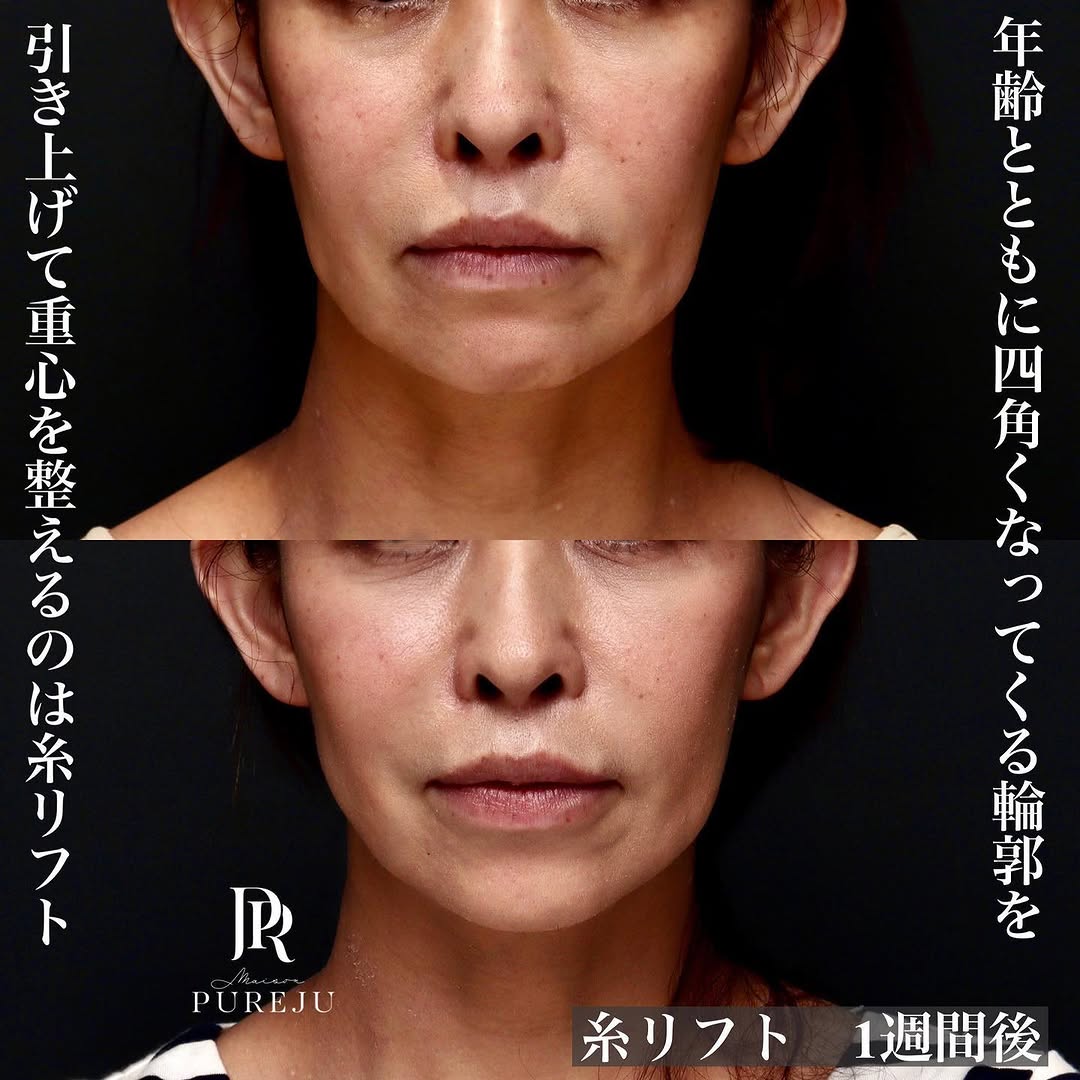 糸リフトとあごボトックスで四角くなった輪郭を整えた症例（術後1週間）