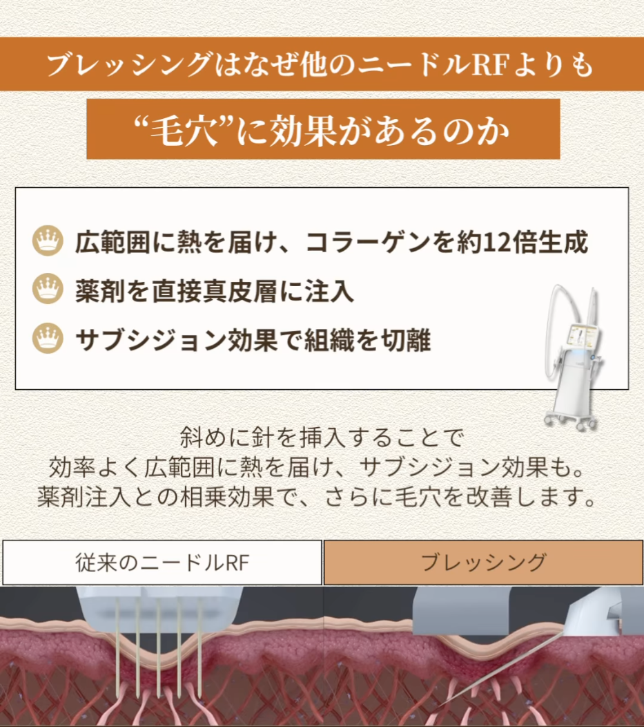 ブレッシング3回照射で頬と鼻の開き毛穴・クレーター・赤みを改善した症例（1ヶ月後） 画像2