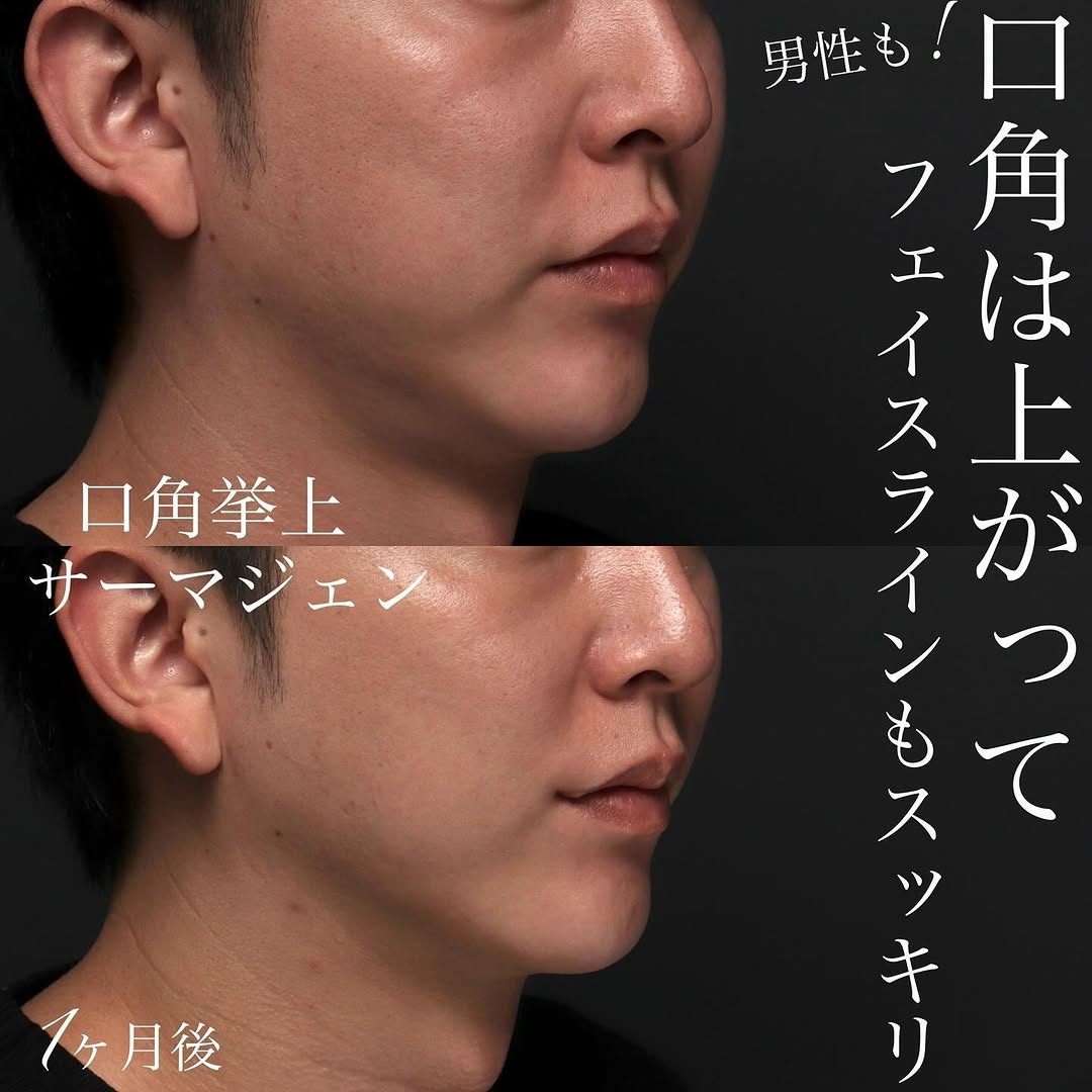 男性の口角挙上＋サーマジェンでフェイスラインのもたつきも整えた症例（術後1ヶ月）