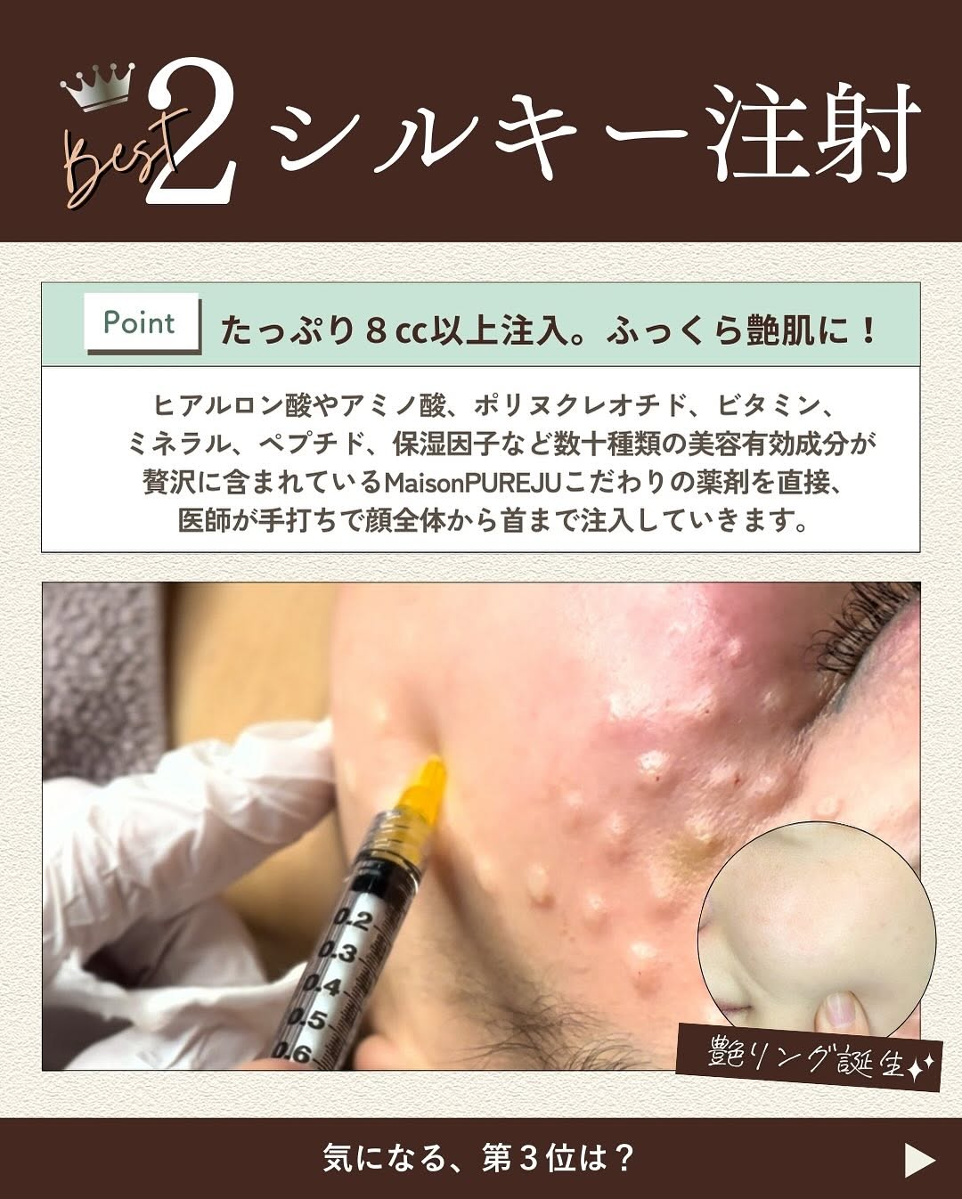2025年上半期 人気治療ベスト3｜XERF・うるおいシルキー注射・ジェネシスが選ばれる理由 画像3