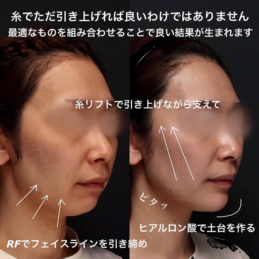糸リフト×サーマジェン×ヒアルロン酸のコンビネーション治療でフェイスラインを整える 画像2